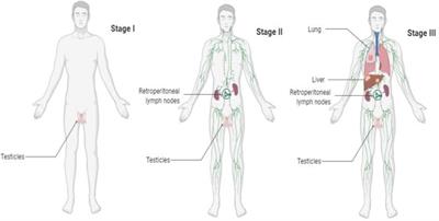 Intricacies of Radiographic Assessment in Testicular Germ Cell Tumors